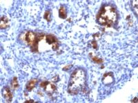 Formalin-fixed, paraffin-embedded human Gastric Carcinoma stained with MUC3 Monoclonal Antibody (MUC3/1154).