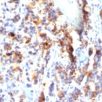 Formalin-fixed, paraffin-embedded human Gastric Carcinoma stained with MUC5AC Monoclonal Antibody (SPM297).