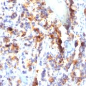 Formalin-fixed, paraffin-embedded human Gastric Carcinoma stained with MUC5AC Monoclonal Antibody (SPM297).