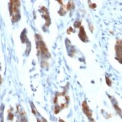 Formalin-fixed, paraffin-embedded human Gastric Carcinoma stained with MUC5AC Monoclonal Antibody (58M1).
