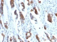 Formalin-fixed, paraffin-embedded human Gastric Carcinoma stained with MUC5AC Monoclonal Antibody (58M1).