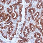 Formalin-fixed, paraffin-embedded human Gastric Carcinoma stained with MUC5AC Monoclonal Antibody (CLH2).