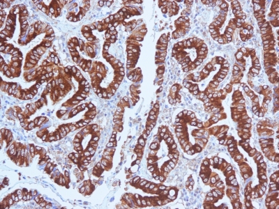 Formalin-fixed, paraffin-embedded human Gastric Carcinoma stained with MUC5AC Monoclonal Antibody (CLH2).