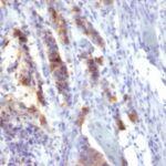 Formalin-fixed, paraffin-embedded human Gastric Carcinoma stained with MUC5AC Monoclonal Antibody (SPM488).