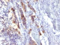 Formalin-fixed, paraffin-embedded human Gastric Carcinoma stained with MUC5AC Monoclonal Antibody (SPM488).