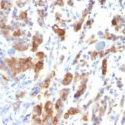 Formalin-fixed, paraffin-embedded human Gastric Carcinoma stained with MUC5AC Monoclonal Antibody (MUC5AC/917).