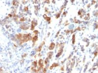 Formalin-fixed, paraffin-embedded human Gastric Carcinoma stained with MUC5AC Monoclonal Antibody (MUC5AC/917).