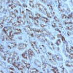 Formalin-fixed, paraffin-embedded human Gastric Carcinoma stained with MUC6 Monoclonal Antibody (CLH5).