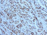 Formalin-fixed, paraffin-embedded human Gastric Carcinoma stained with MUC6 Monoclonal Antibody (CLH5).