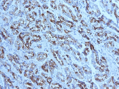 Formalin-fixed, paraffin-embedded human Gastric Carcinoma stained with MUC6 Monoclonal Antibody (CLH5).