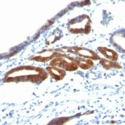 Formalin-fixed, paraffin-embedded human Gastric Carcinoma stained with MUC6 Monoclonal Antibody (SPM598).
