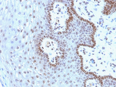 c-myc Monoclonal Antibody (9E1.3) staining of FFPE human Cervical Carcinoma sections. HIER epitope retrieval was performed using 10 mM Tris, 1 mM EDTA (pH 9.0). Antibody was diluted 1:200 (1ug/ml).