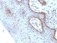 Formalin-fixed, paraffin-embedded human Cervical Carcinoma stained with c-myc Monoclonal Antibody (SPM237).