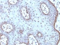 Formalin-fixed, paraffin-embedded human Cervical Carcinoma stained with c-myc Monoclonal Antibody (MYC99).