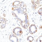 Formalin-fixed, paraffin-embedded human Leiomyosarcoma stained with SM-MHC Monoclonal Antibody (SMMS-1).