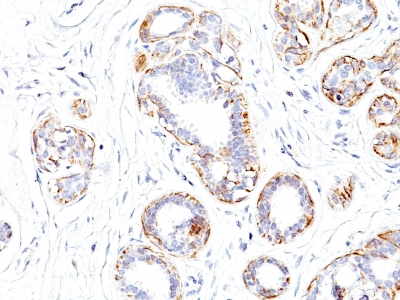 Formalin-fixed, paraffin-embedded human Leiomyosarcoma stained with SM-MHC Monoclonal Antibody (SMMS-1).