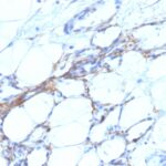 Formalin-fixed, paraffin-embedded human Angiosarcoma stained with SM-MHC Monoclonal Antibody (SPM21).