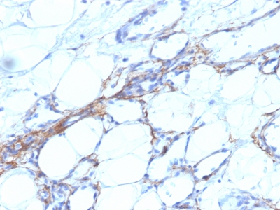 Formalin-fixed, paraffin-embedded human Angiosarcoma stained with SM-MHC Monoclonal Antibody (SPM21).