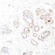 Formalin-fixed, paraffin-embedded human Leiomyosarcoma stained with SM-MHC Monoclonal Antibody (ID8).