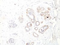 Formalin-fixed, paraffin-embedded human Leiomyosarcoma stained with SM-MHC Monoclonal Antibody (ID8).