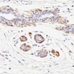 Formalin-fixed, paraffin-embedded human Leiomyosarcoma stained with SM-MHC Monoclonal Antibody (MYH11/923).