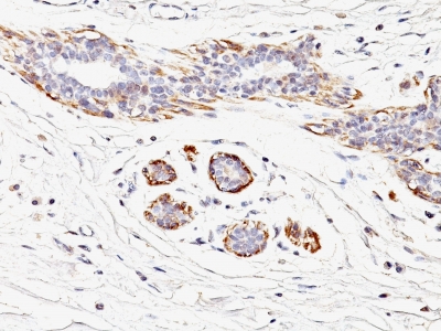 Formalin-fixed, paraffin-embedded human Leiomyosarcoma stained with SM-MHC Monoclonal Antibody (MYH11/923).