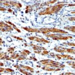 Formalin-fixed, paraffin-embedded human Breast Carcinoma stained with SM-MHC Monoclonal Antibody (MYH11/923 + SMMS-1).