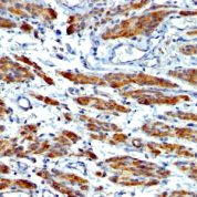Formalin-fixed, paraffin-embedded human Breast Carcinoma stained with SM-MHC Monoclonal Antibody (MYH11/923 + SMMS-1).