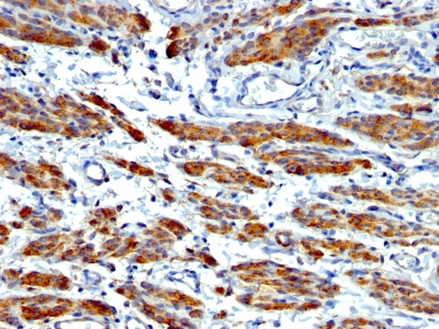 Formalin-fixed, paraffin-embedded human Breast Carcinoma stained with SM-MHC Monoclonal Antibody (MYH11/923 + SMMS-1).