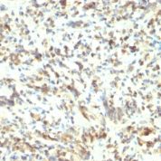 Formalin-fixed, paraffin-embedded human Rhabdomyosarcoma stained with MyoD1 Monoclonal Antibody (5.8A)