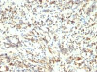 Formalin-fixed, paraffin-embedded human Rhabdomyosarcoma stained with MyoD1 Monoclonal Antibody (5.8A)