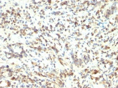 Formalin-fixed, paraffin-embedded human Rhabdomyosarcoma stained with MyoD1 Monoclonal Antibody (5.8A)