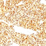 Formalin-fixed, paraffin-embedded human Rhabdomyosarcoma stained with MyoD1 Monoclonal Antibody (SPM427)