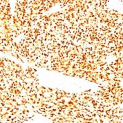 Formalin-fixed, paraffin-embedded human Rhabdomyosarcoma stained with MyoD1 Monoclonal Antibody (SPM427)