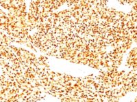 Formalin-fixed, paraffin-embedded human Rhabdomyosarcoma stained with MyoD1 Monoclonal Antibody (SPM427)