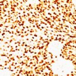 Formalin-fixed, paraffin-embedded human Rhabdomyosarcoma stained with MyoD1 Monoclonal Antibody (MYD712)