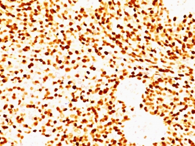 Formalin-fixed, paraffin-embedded human Rhabdomyosarcoma stained with MyoD1 Monoclonal Antibody (MYD712)