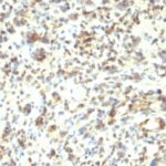 Formalin-fixed, paraffin-embedded human Rhabdomyosarcoma stained with MyoD1 Monoclonal Antibody (5.8A + MYD712)