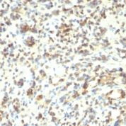 Formalin-fixed, paraffin-embedded human Rhabdomyosarcoma stained with MyoD1 Monoclonal Antibody (5.8A + MYD712)