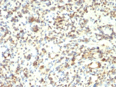 Formalin-fixed, paraffin-embedded human Rhabdomyosarcoma stained with MyoD1 Monoclonal Antibody (5.8A + MYD712)