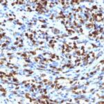 Formalin-fixed, paraffin-embedded Rhabdomyosarcoma stained with Myogenin Monoclonal Antibody (MGN185)