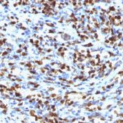 Formalin-fixed, paraffin-embedded Rhabdomyosarcoma stained with Myogenin Monoclonal Antibody (MGN185)