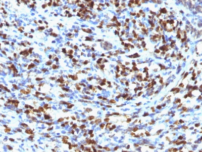 Formalin-fixed, paraffin-embedded Rhabdomyosarcoma stained with Myogenin Monoclonal Antibody (MGN185)