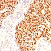 Formalin-fixed, paraffin-embedded human Rhabdomyosarcoma stained with Myogenin Monoclonal Antibody (F5D)