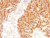 Formalin-fixed, paraffin-embedded human Rhabdomyosarcoma stained with Myogenin Monoclonal Antibody (F5D)