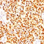 Formalin-fixed, paraffin-embedded human Rhabdomyosarcoma stained with Myogenin Monoclonal Antibody (SPM144)