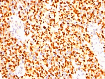 Formalin-fixed, paraffin-embedded human Rhabdomyosarcoma stained with Myogenin Monoclonal Antibody (SPM144)