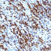 Formalin-fixed, paraffin-embedded human Rhabdomyosarcoma stained with Myogenin Monoclonal Antibody (MGN185+F5D)