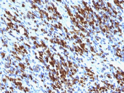 Formalin-fixed, paraffin-embedded human Rhabdomyosarcoma stained with Myogenin Monoclonal Antibody (MGN185+F5D)