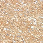 Formalin-fixed, paraffin-embedded human Brain Tumor stained with CD56 Monoclonal Antibody (123A8)